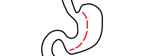 tubulizace žaludku